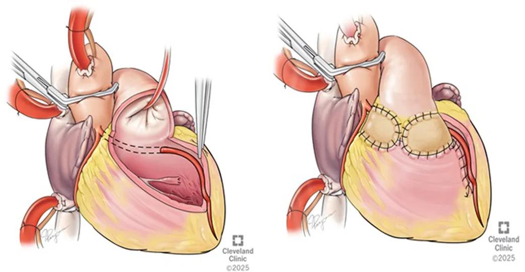 side-by-side illustrations of steps in a heart operation