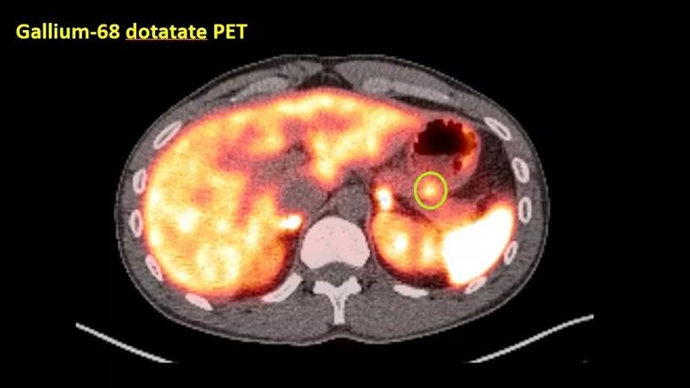 PET scan image of lesion.