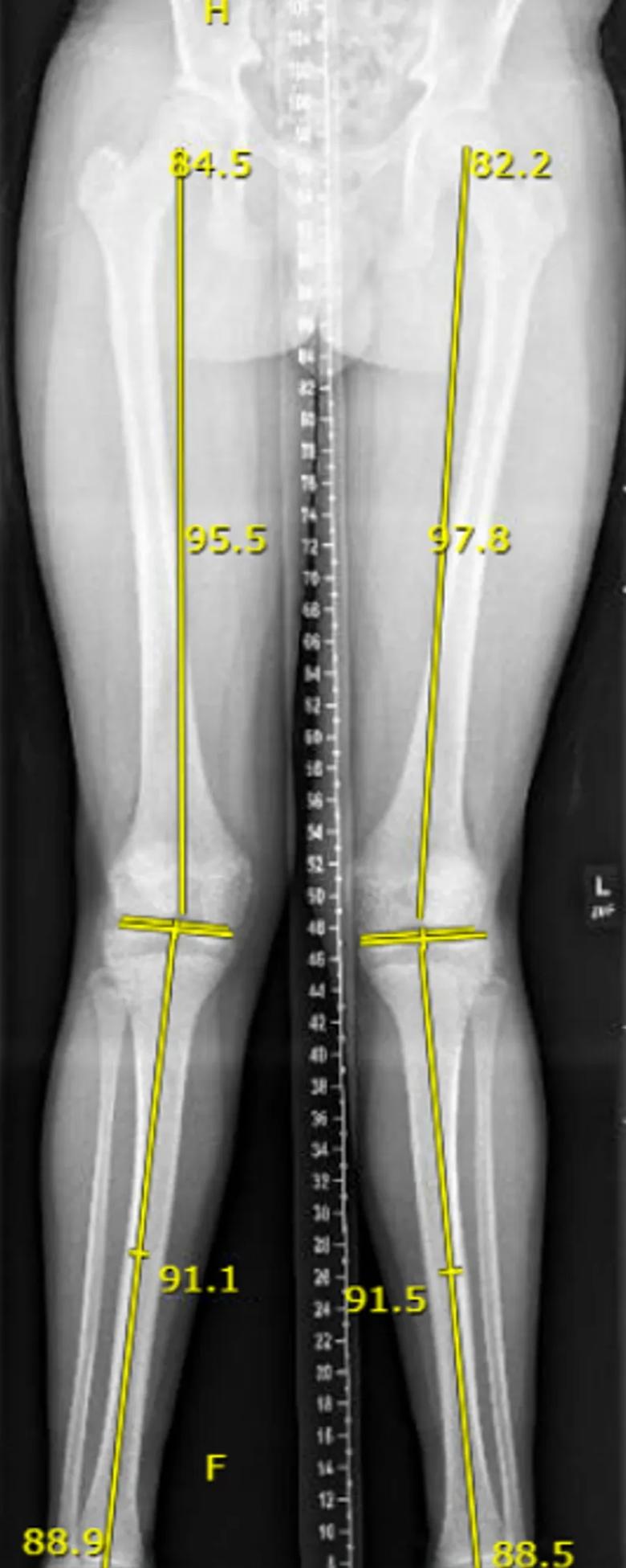 X-ray with measurements of patient with genu valgum 