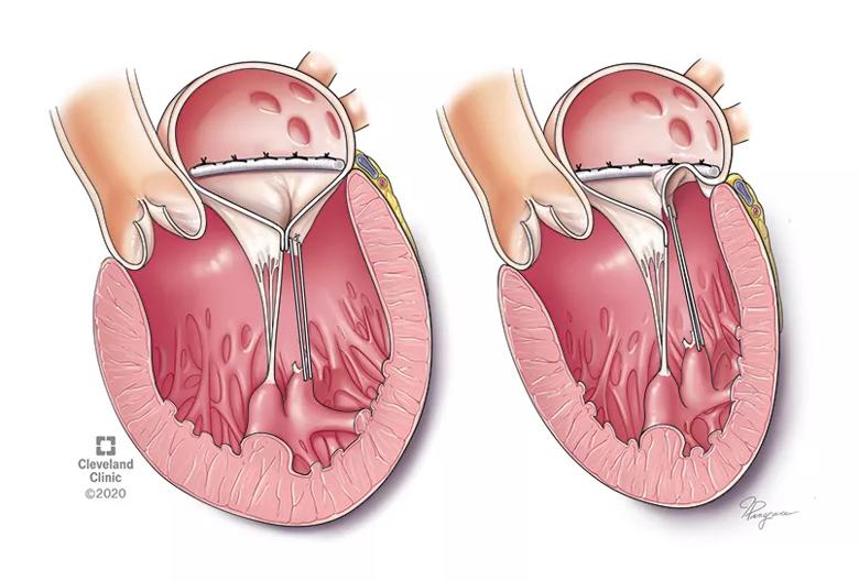illustrations of heart chambers showing recurrent mitral regurgitation