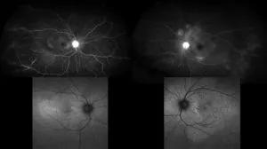 Optical coherence tomography showing the retinal pigment epithelium