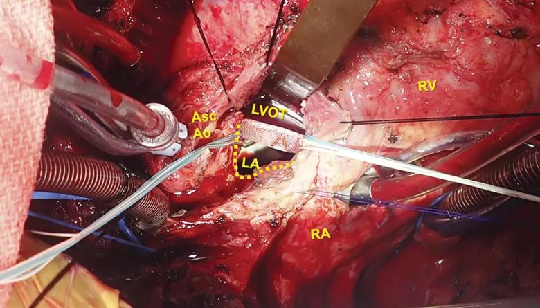 operative field during a heart operation