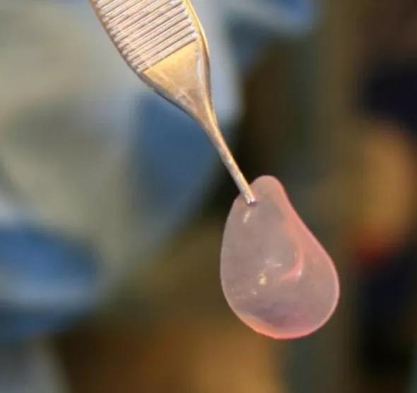 Figure 1. Engineered tissue graft for a knee articular cartilage lesion.