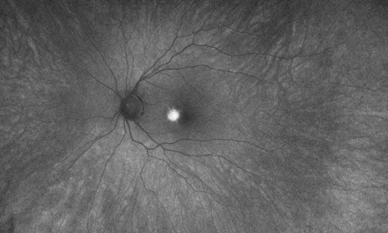 Fundus photo