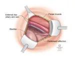 D. Exposure of iliopsoas fascia after positioning of self-retaining retractor