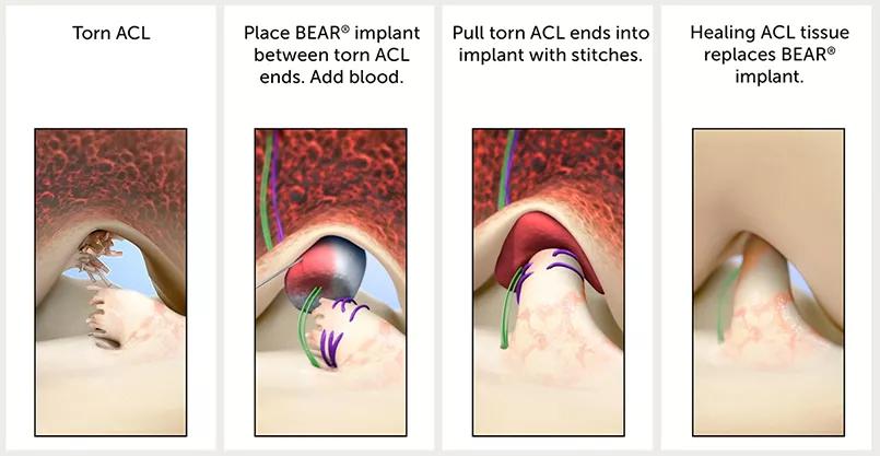 Stages of ACL repair with the BEAR implant.