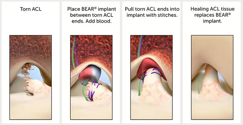 Stages of ACL repair with the BEAR implant.