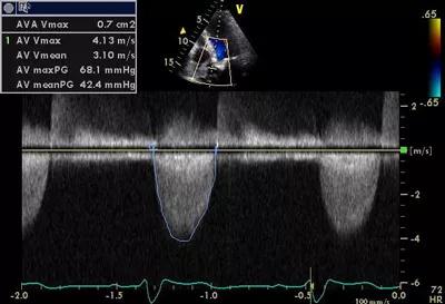 Figure 1. Echocardiography findings showing aortic velocity upon the patient’s presentation.