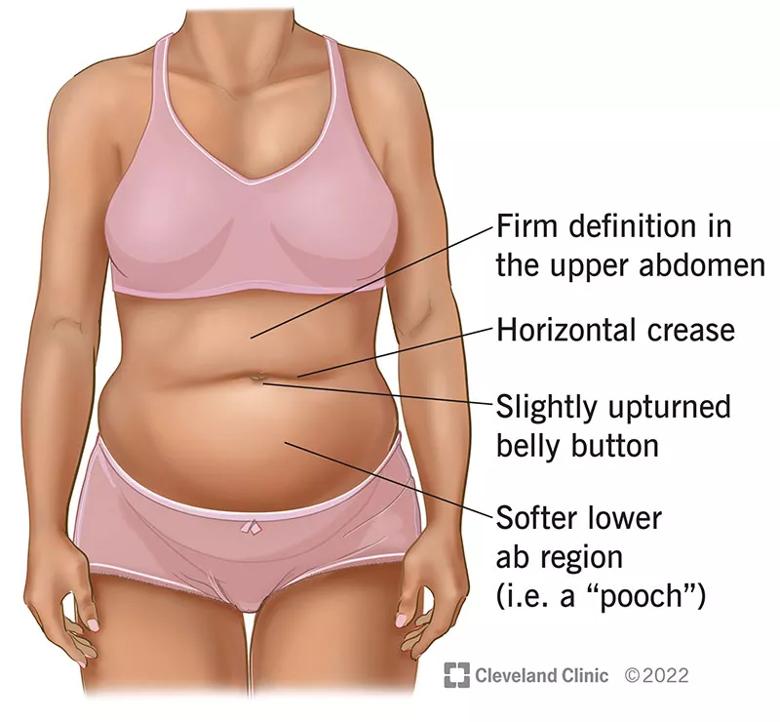 hourglass syndrome: Often suck your stomach in to look slimmer in