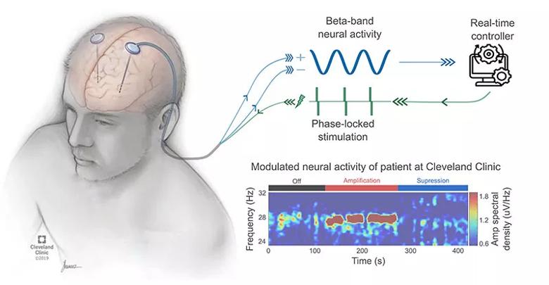 Schematic of closed-loop evoked interference deep brain stimulation