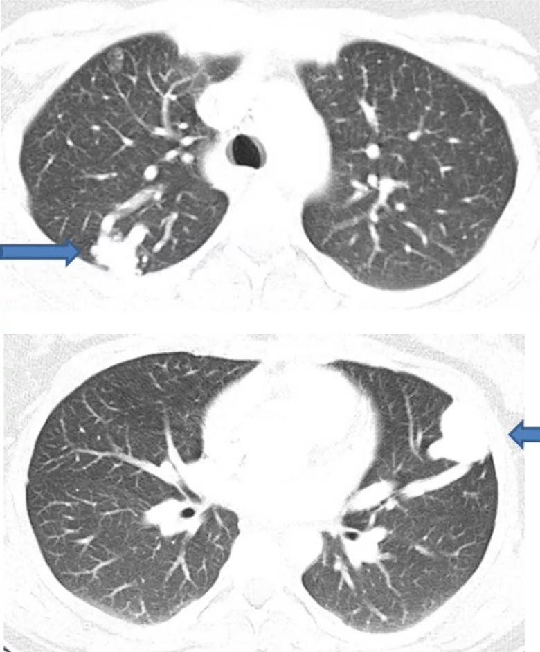 CT chest with contrast