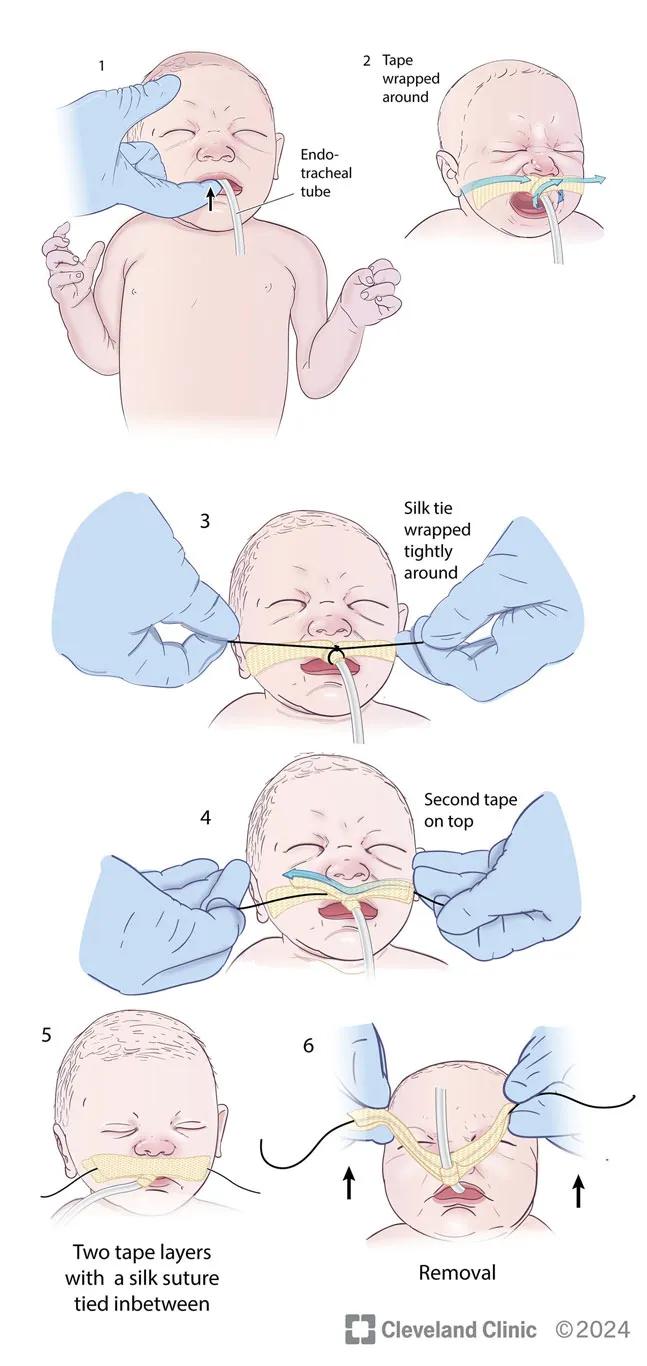 Illustration showing silk suture tie method
