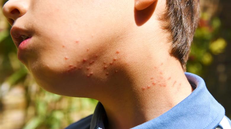 multiple chigger bites on a young person's neck and chin