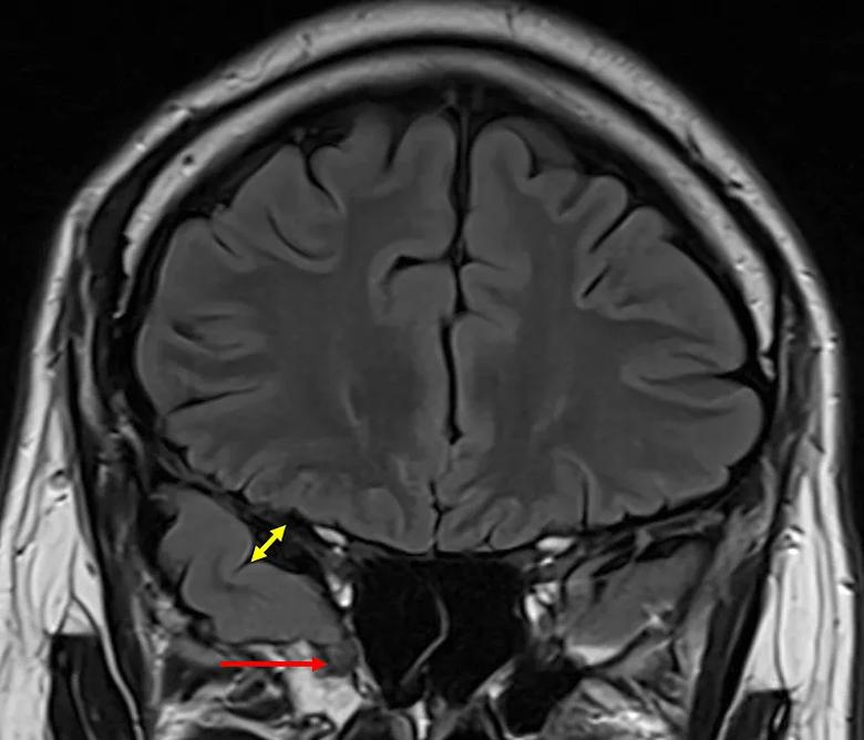 brain MRI with a red arrow and double-sided yellow arrow