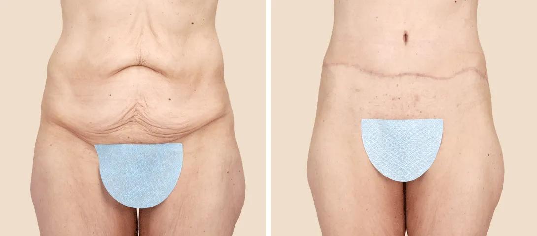 Before circumferential abdominoplasty (left) and 6 months after surgery (right).