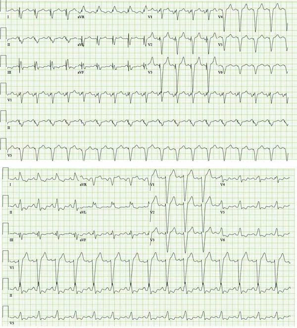Figure 1. The patient’s ECGs upon presentation (left) and with suppression of biventricular pacing (right).