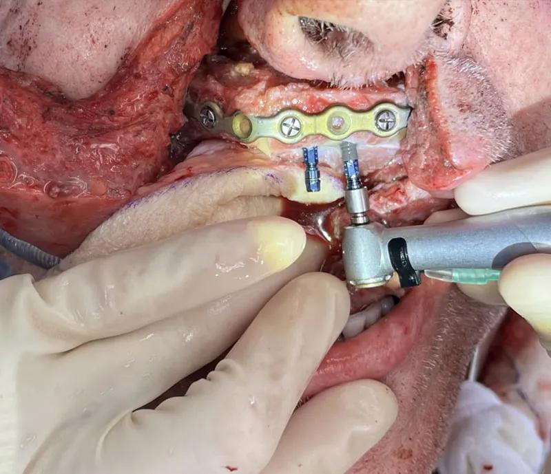 Dental implants placed during the same operation as the cancer removal and free flap reconstruction 