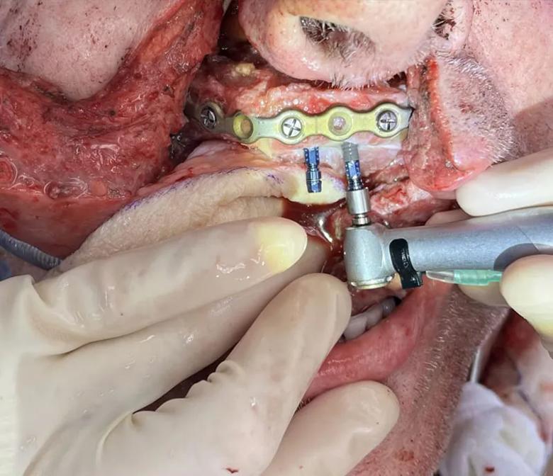 Dental implants placed during the same operation as the cancer removal and free flap reconstruction 