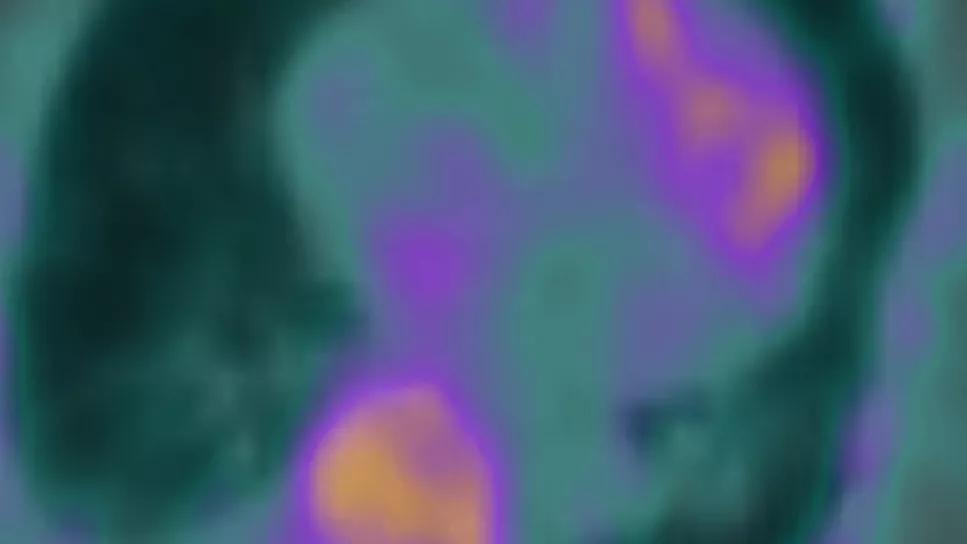 Atrial Uptake on Cardiac Scintigraphy With 99mTc-PyP Signals 