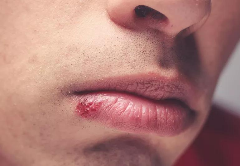 Cold Sore vs Pimple: How to Prevent, Treat, and Tell the Difference Between  Them