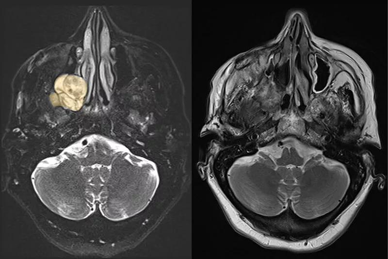 two brain scans side by side, with the one on the left showing a mass that's missing in the right scan