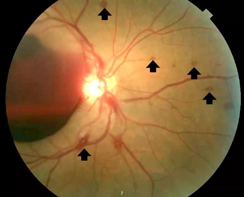 Multiple white-centered intraretinal hemorrhages or Roth spots (arrows) were noted in the right eye.