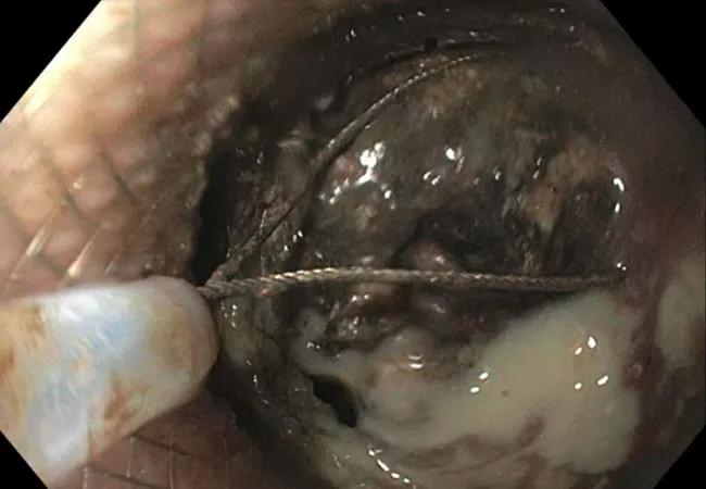 This image shows a stent extending from the stomach into an infected, walled-off pancreatic necrotic region. A snare is used to remove necrotic tissue. 