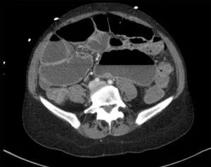 Deep infiltrating endometriosis