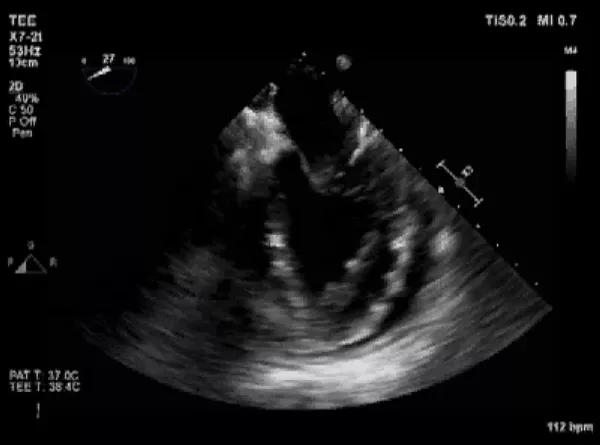 Echocardiogram