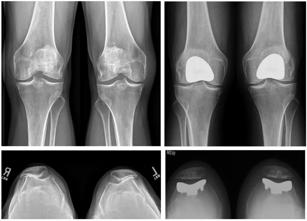 X-rays after bilateral unicompartmental knee arthroplasty