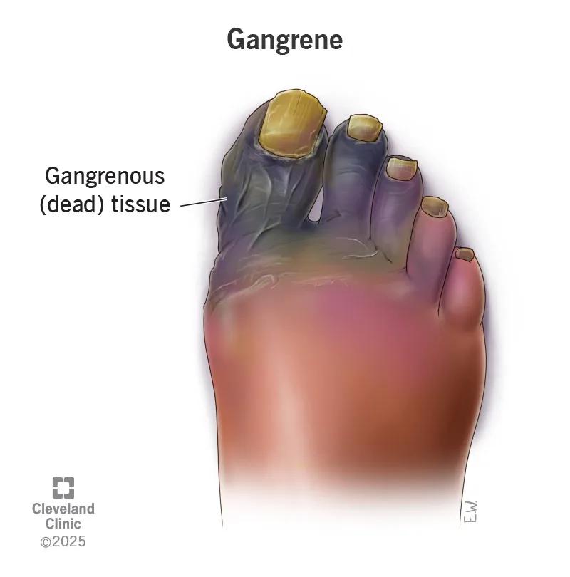 Gangrenous (dead) tissue on part of foot, including several black, purple and green toes