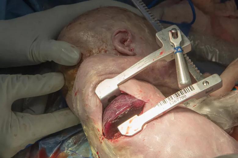 Photo of fetal surgery.