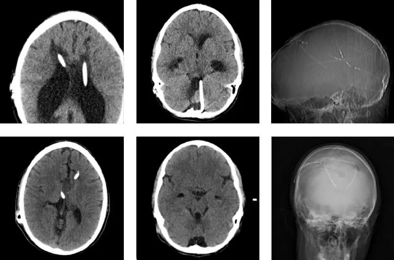 Ventricular shunt system failure in a young adult
