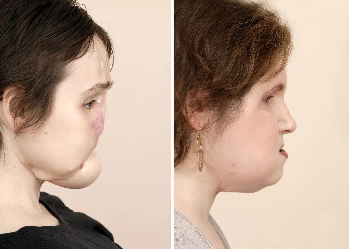 Katie Stubblefield face transplant Cleveland Clinic