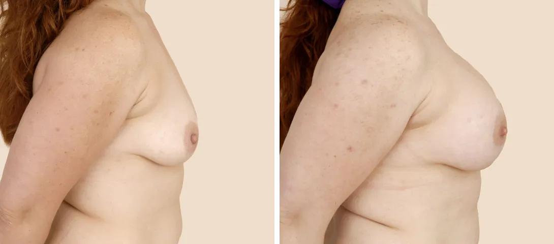 Breast augmentation before & after photo