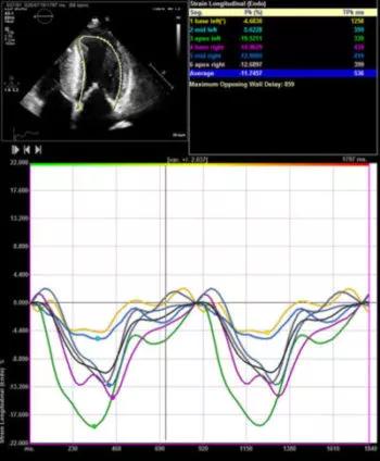 LV Strain May Offer Independent Prognostic Utility in Obstructive Hypertrophic Cardiomyopathy