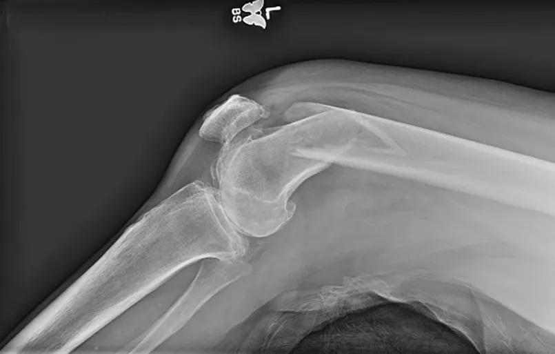 X-ray of distal femur fracture