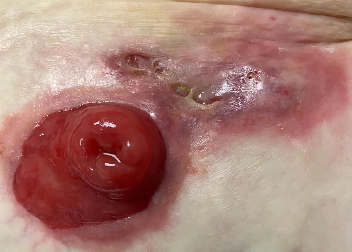 Example of pyoderma Pyoderma gangrenosum 