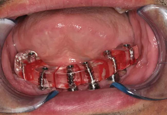 The patient subsequently underwent surgical placement of six bone-level implants into the reconstructed mandible