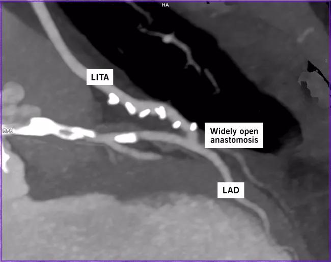  CT coronary angiogram showing a patent left ITA (LITA) with clips on its branches