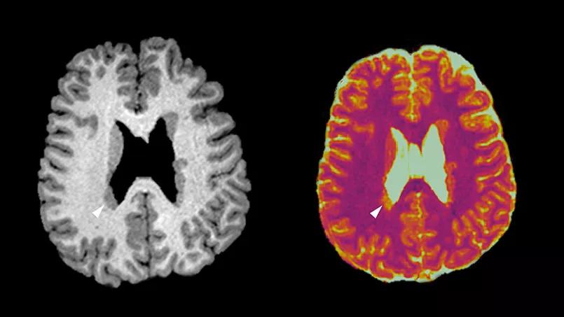 two side-by-side human brain MRIs