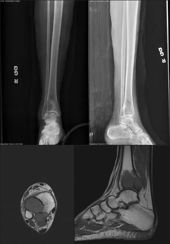 Figure 2. Radiographs and MRIs of the case patient H.C. after presentation several years after removal of a giant cell tumor of bone. The radiographs on the top reveal two lytic lesions within the lateral aspect of the distal tibia. The MRIs on the bottom show recurrence of her giant cell tumor with aneurysmal bone cyst components