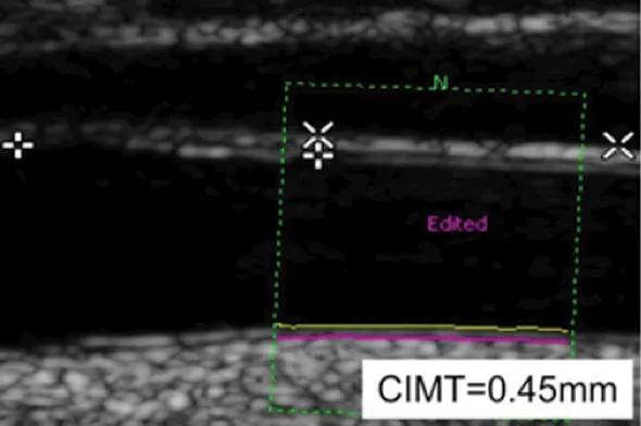 Figure 1. Carotid artery ultrasound images from a control patient (left) and from a PsA patient with carotid artery plaque and a thickened arterial wall CIMT measurement (right). CIMT = carotid intima-media thickness. 