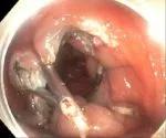 Endoscopic clip closure of the resection site.