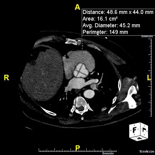 Sample cross-sectional image from a patient with a trileaflet aortic valve and a dilated aortic root. This patient’s ratio of aortic root cross-sectional area to height was 10.4 cm2/m.