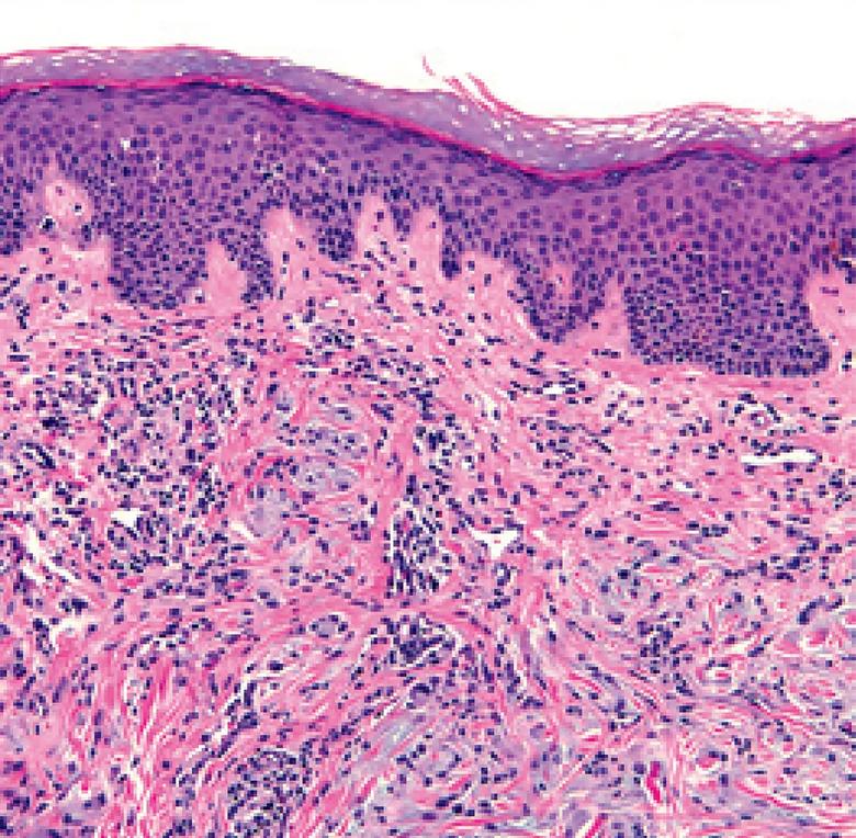 Skin biopsy from the neck