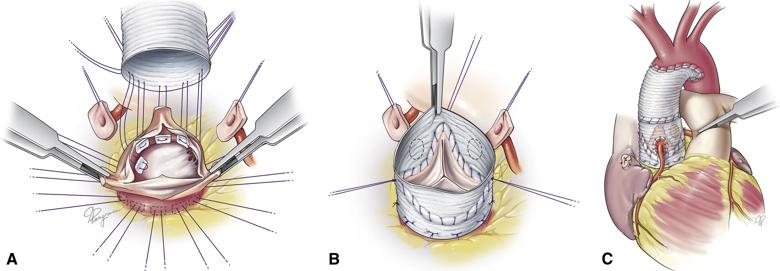 three steps in a heart valve operation