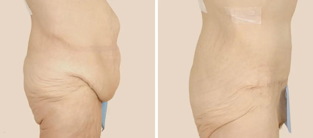 Before tummy tuck (left) and 13 months after tummy tuck (right).