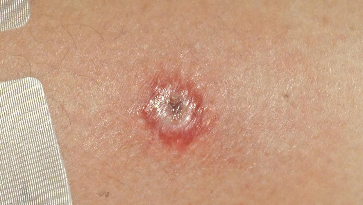 How To Identify 8 Common Bug Bites