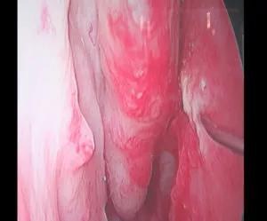 Submucosal injections of sodium tetrdecyl sulfate (STS)